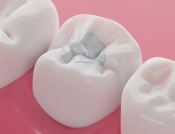 3D illustration of white composite resin filling material placed in a tooth cavity.