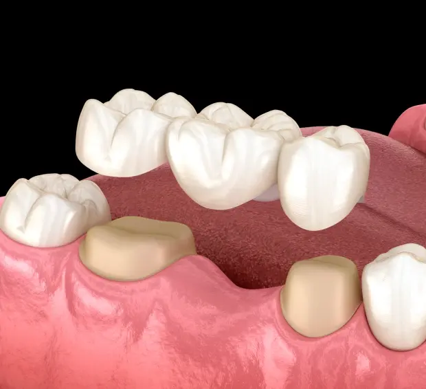 Dental bridge illustration showing tooth replacement spanning missing teeth in the jaw.