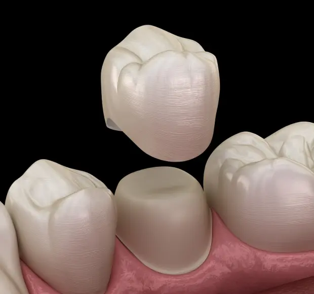 Dental crown restoration showing tooth-colored ceramic crowns on gum model.