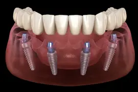 All-on-Four dental implants showing prosthetic teeth anchored to jawbone implants in Monterey Park.