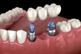 3D dental implant bridge illustration showing two implant fixtures in jawbone with ceramic tooth replacements.