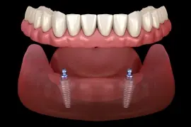 Implant supported denture showing two dental implants with a full upper denture in Monterey Park.