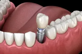 Single tooth dental implant illustration showing implant placement between natural teeth.